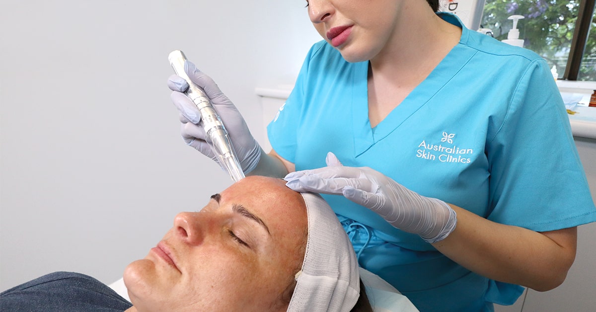 MesoInfus™ Needling - Face Featured Image