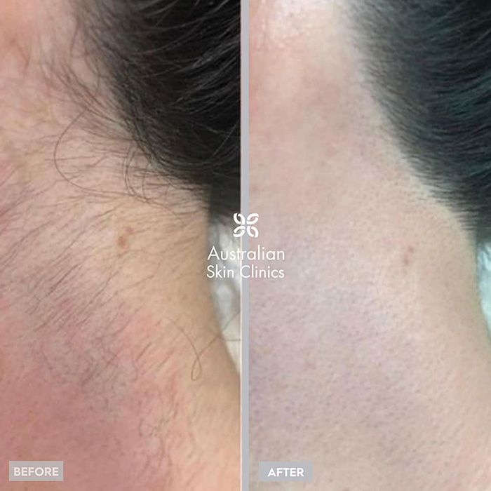 Before and After Picture of Patient After Getting a Laser Hair Removal Treatment