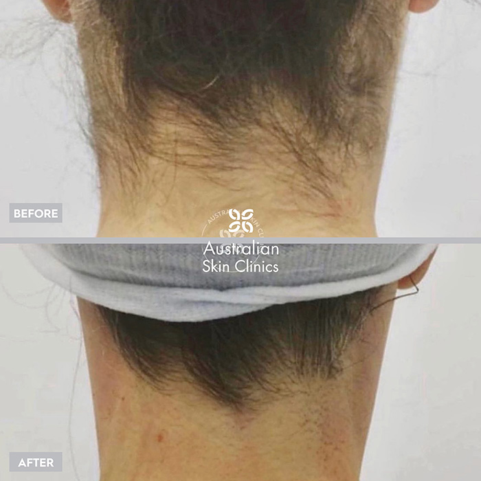 Before and After Picture of Patient After Getting a Laser Hair Removal Treatment