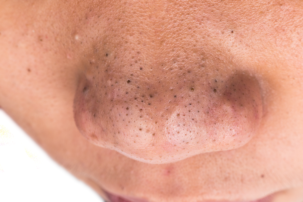 Blackheads Treatment - Australian Skin Clinics