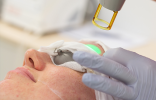 Laser for Pigmentation - Full Face Featured Image